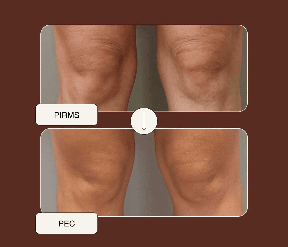 RF-Lifting-Ergebnis — vorher und nachher